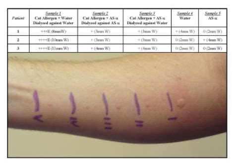 scratch test results|how to read allergy skin test results chart.